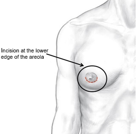 gynecomastia surgery tunisia